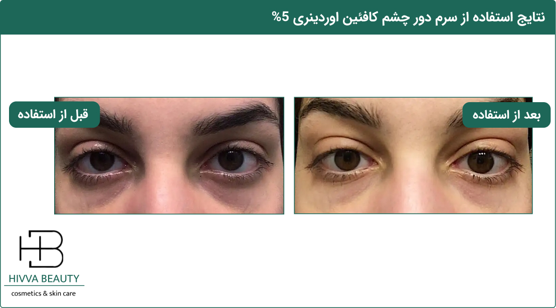 قبل و بعد استفاده از سرم دور چشم کافئین اوردینری 5% 