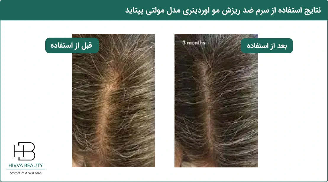 قبل و بعد استفاده از سرم ضد ریزش مو اوردینری مدل مولتی پپتاید