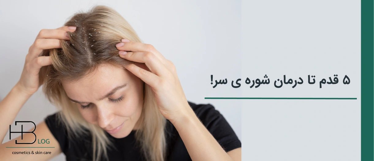 ۵ راه حل خانگی برای درمان شوره سر